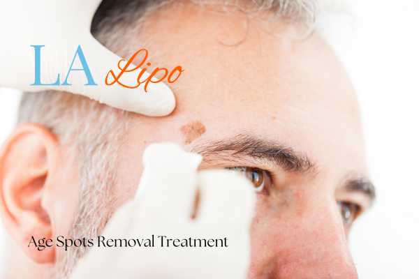 What Are the Most Effective Treatments for Age Spots Sandy?