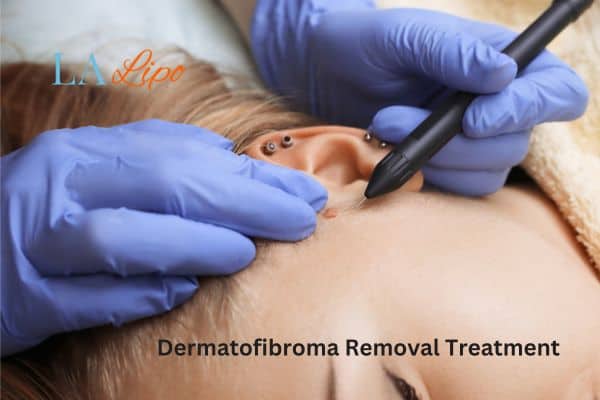 Dermatofibroma Removal Treatment Sandy