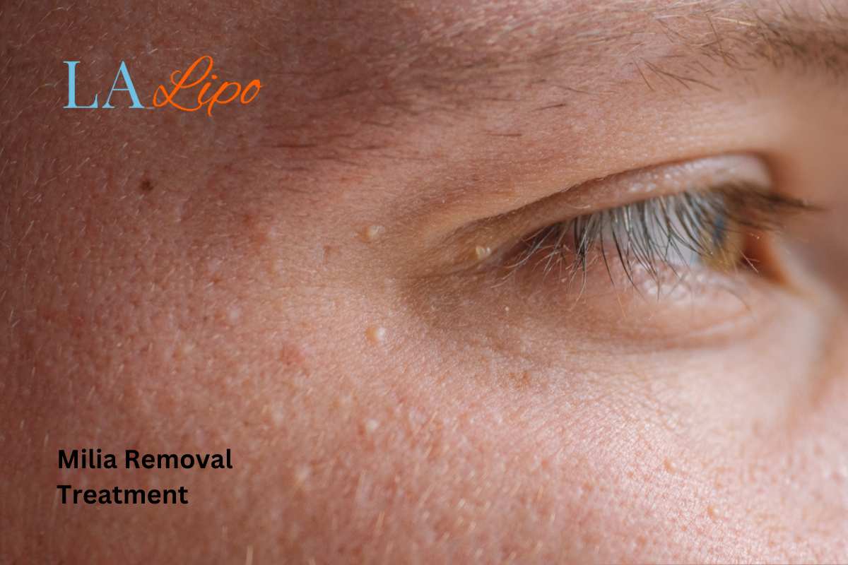 Cryopen Milia Removal: Is It the Easiest and Safest Option Sandy?