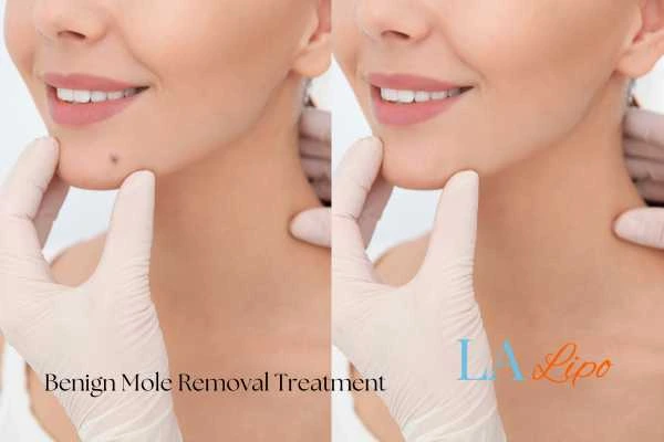 woman's before and after mole removal Sandy results
