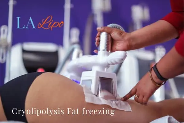 women getting fat freezing Sandy
