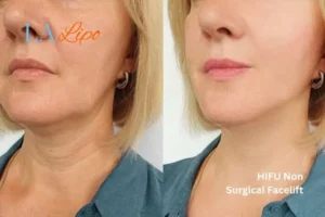 hi-fu for wrinkles Sandy before and after results