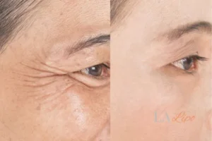 Before and after results of woman - HI-fu wrinkles reduction treatment Sandy