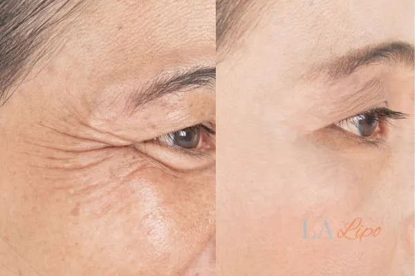 Before and after results of woman - HI-fu wrinkles reduction treatment Sandy
