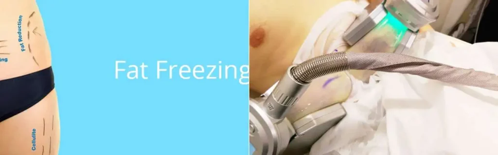 Fat freezing Sandy on multiple areas of the body