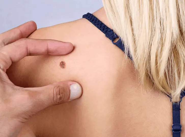 woman having mole removal Sandy consultation before treatment.