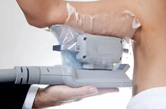 Picture of fat freezing Sandy on the upper arms.