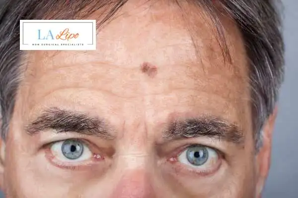 Solar Lentigo Removal Sandy image of man with mark on his forehead