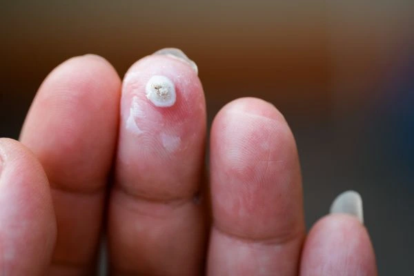 wart on person finger - cryotherapy to treat from LA LIPO Sandy