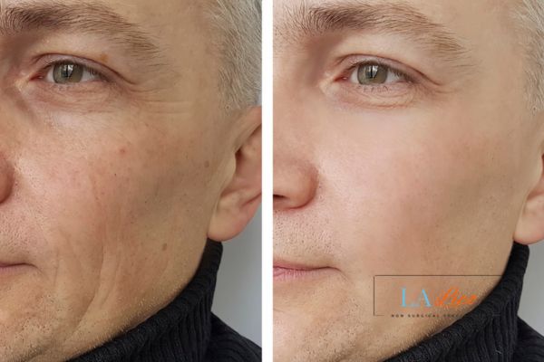 See the amazing results of Morpheus8 Treatment Sandy!