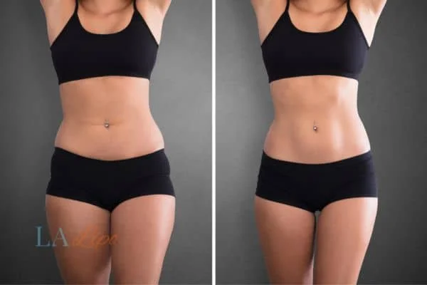 before and after results of non-surgical treatment to help a woman's body image and mental health Sandy