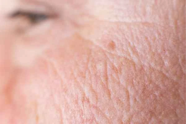 close up picture of a woman's face showing an age spot Sandy