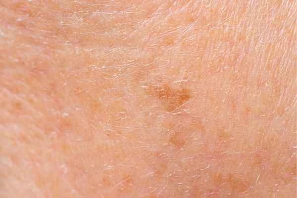 close up picture of age spots Sandy