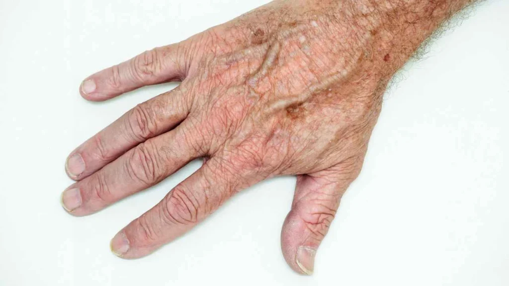 Male hand showing age spot Sandy
