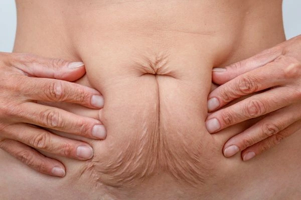 Should I Combine Diastasis Recti Treatment with Body Contouring for Better Results Sandy?