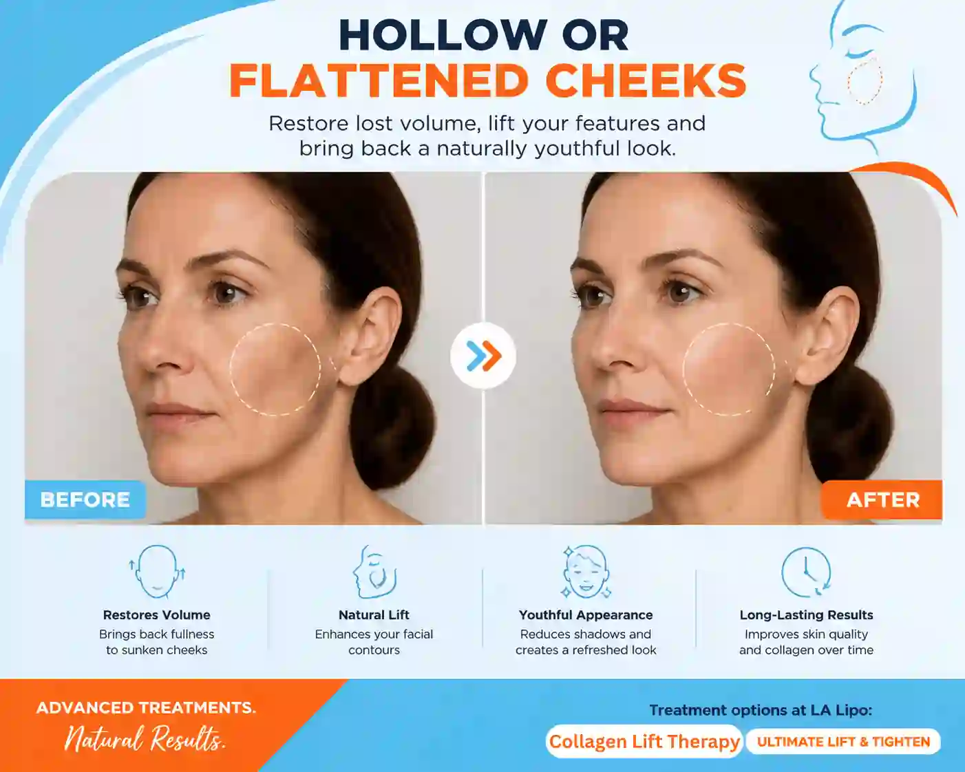 Sign #4: Hollow or Flattened Cheeks Sandy