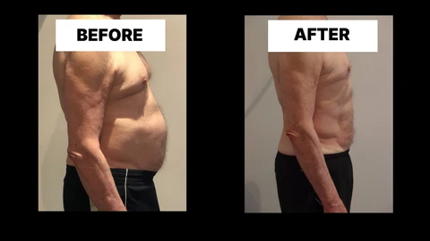 What Symptoms Can Diastasis Recti Cause in Men? Weak Core, Back Pain and Poor Posture Sandy